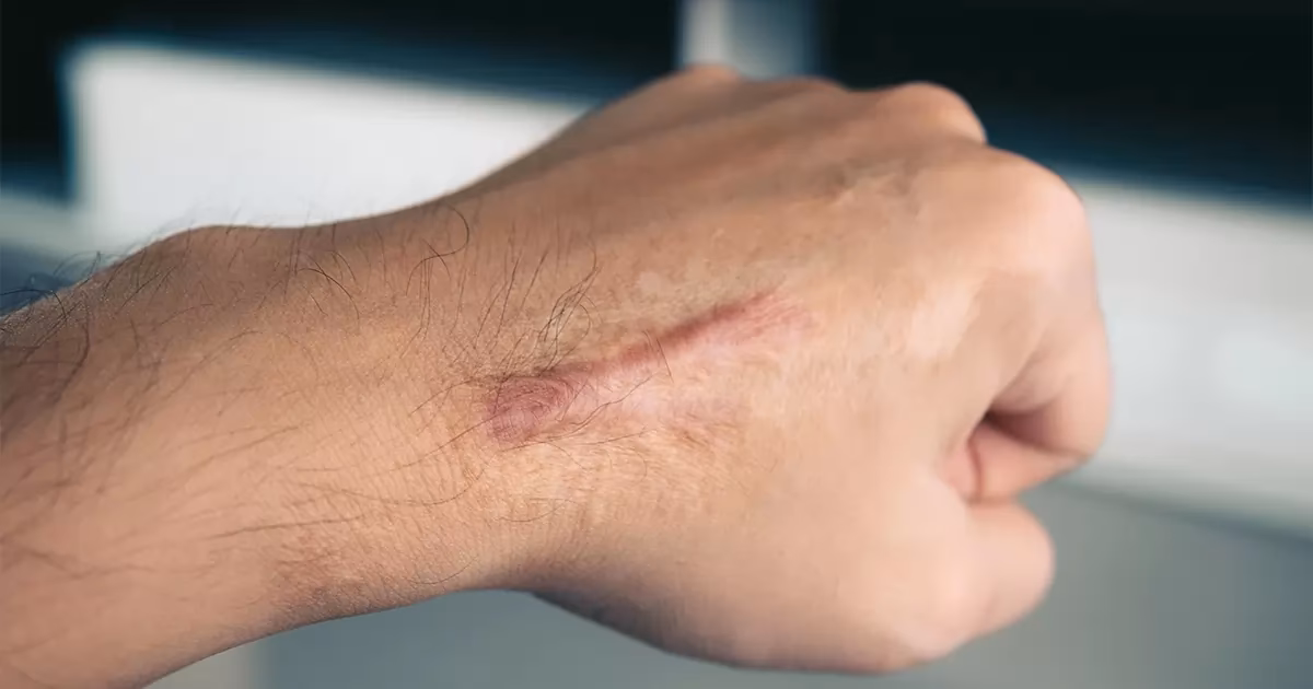 How to get rid of big scar tissue?